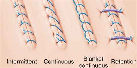 A Suture Is An Example Of