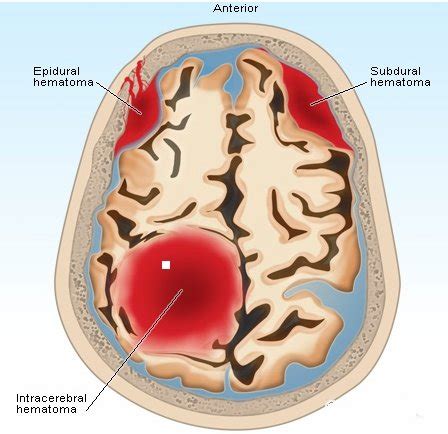 An Indicator Of An Expanding Intracranial Hematoma