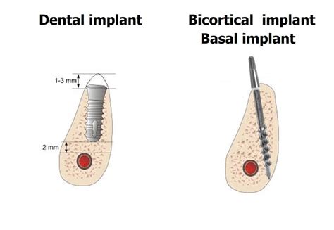 Are Implants Quarantined Until Results Of Bi Can Be Read