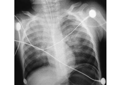 If A Patient With A Chest Injury Only Inhales