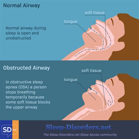 Obstructive Sleep Apnea Occurs When ________.