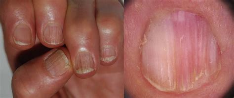 Onychorrhexis Is A Term Indicating The Nail Condition Called