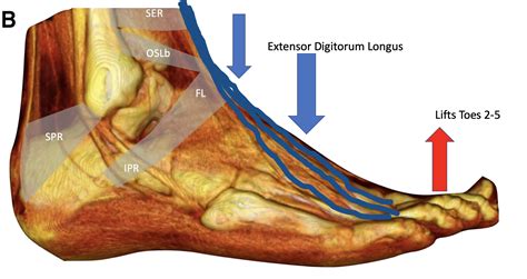 Pain In Extensor Digitorum Longus Muscle