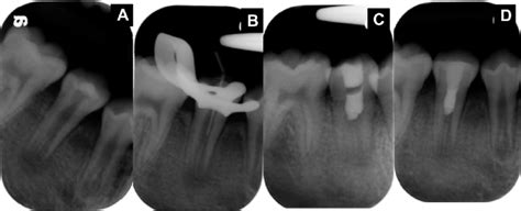 Radiolucent Lesion Apical To Tooth 30