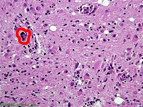 Striated Multinucleate Cells Are Commonly Found In