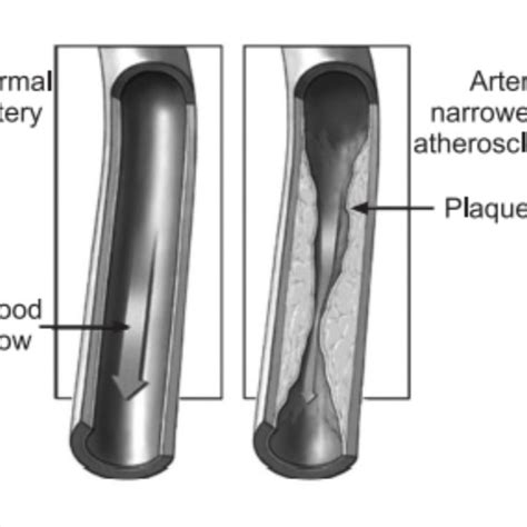 The Terms Multiple Sclerosis And Atherosclerosis Both Refer To