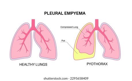 What Does The Word Root In The Term Pyothorax Mean